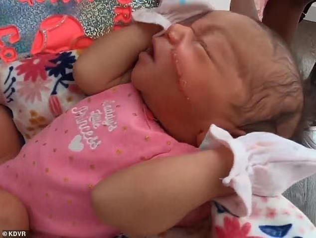 毁容|揪心！剖腹产手术致女婴毁容 严重划伤已缝合13针，未来还需整形