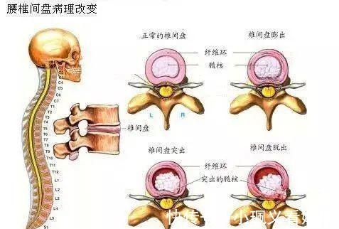 坐骨|厉害了！大蒜配它，解除了3年神经压迫坐骨痛，腰间盘突出拜拜！