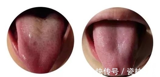 看病|为什么中医看病都要看舌头？教你认识舌苔