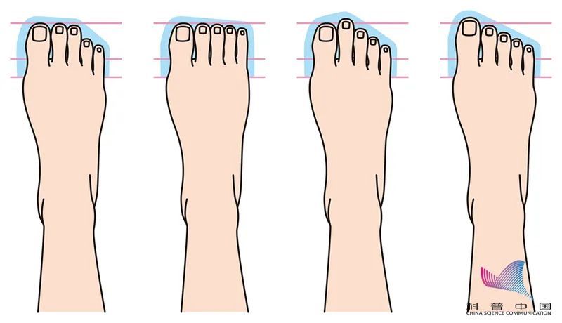神经瘤 女子爱穿尖头鞋竟患上这种“瘤”！不同脚型该怎么选鞋？一次说清楚