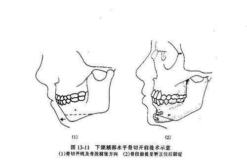 t截骨|下巴整形的3种方法:注射、假体、T截骨,哪个适合你?区别在哪?