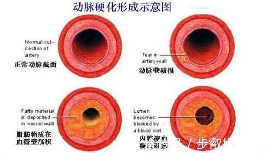 rebecc专家提醒年轻人瑜伽运动不当容易造成中风！