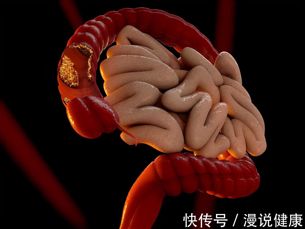 肠癌|抗癌博主阿健病逝:死亡率排名第二!这种癌症开始“盯上”年轻人