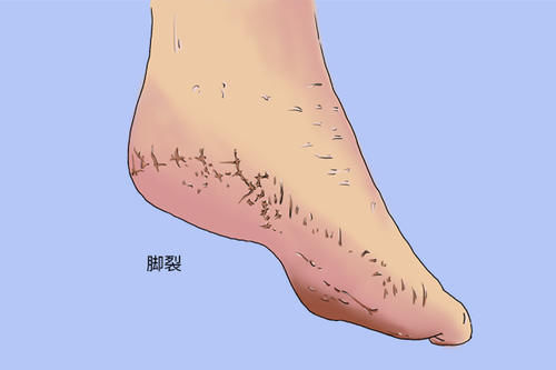 脚部|糖尿病严重了,脚部会有什么变化?哪怕出现一个,也要赶紧检查