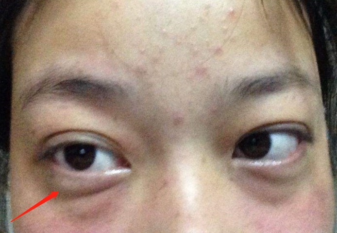 眼角膜|血脂高不高，看脸如果脸上有4种表现，要注意降低血脂了