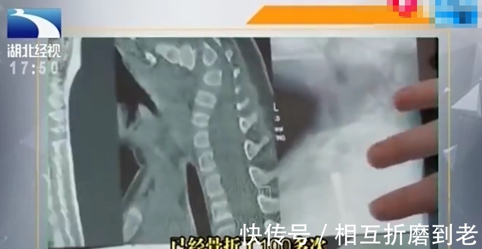 脆弱|最“脆弱”的女孩:1年骨折100多次,打个喷嚏都会骨折