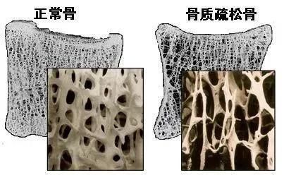 食物|入秋了，养骨黄金期？骨科医生：常吃2种食物，或有助于养骨