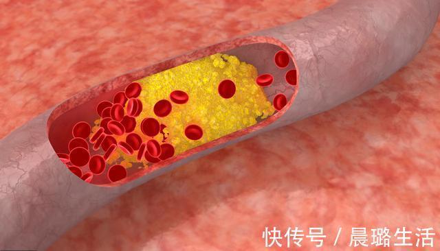 血管健康|血管堵塞的人,早起会有3个表现,若没有,说明血管还算健康