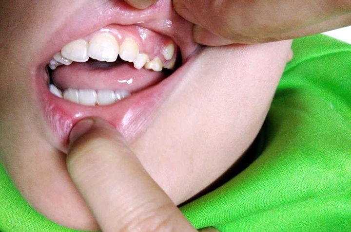 双排牙|6岁孩子长出双排牙,医生询问原因后才得知:都是精细喂养惹的祸