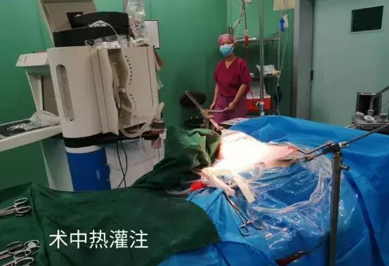 灌注液|腹腔热灌注治疗——结肠癌腹膜转移、恶性腹水预防和治疗的新方案