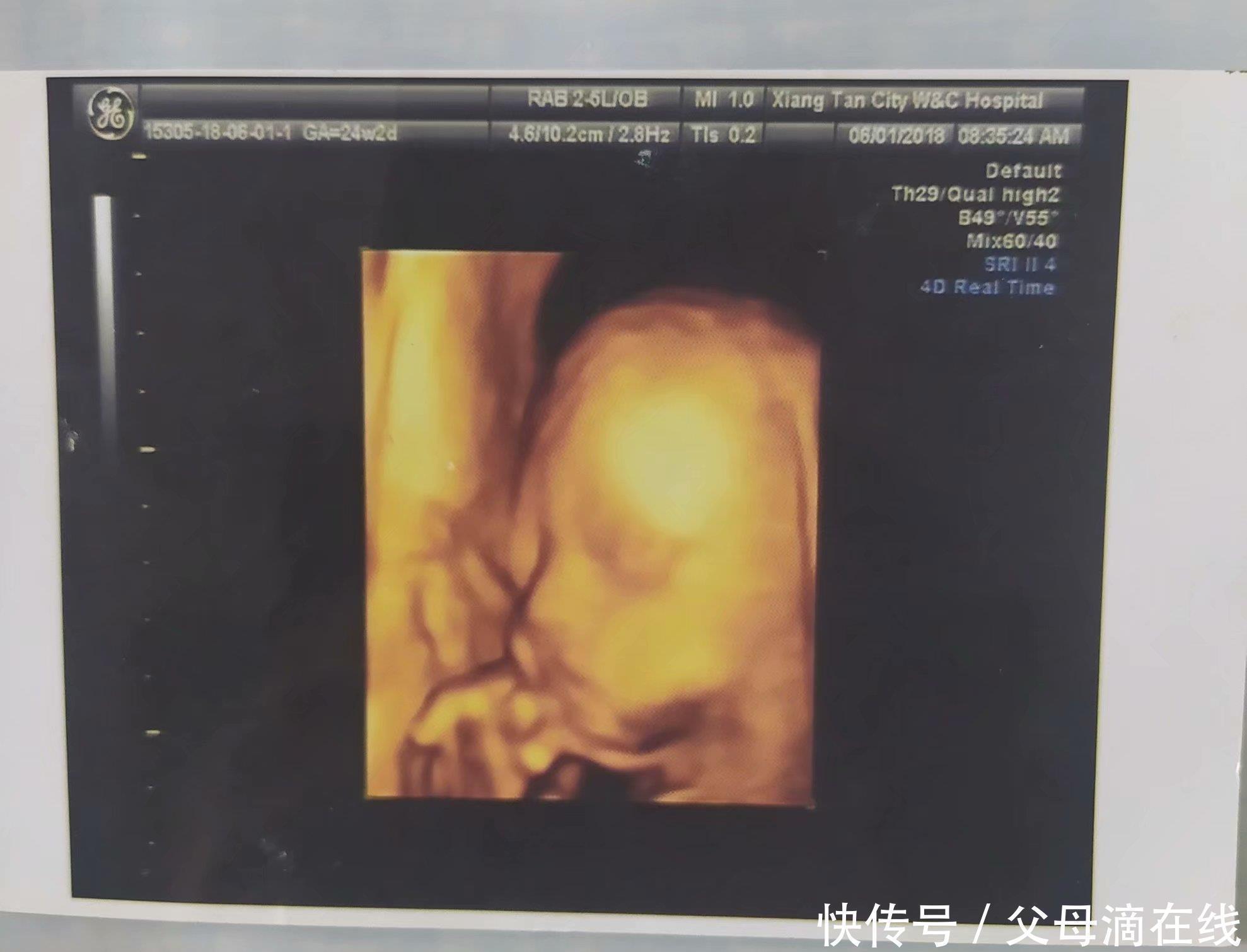 胎动|孕期大排畸检查,快速通过及注意事项,你想知道的都在这里