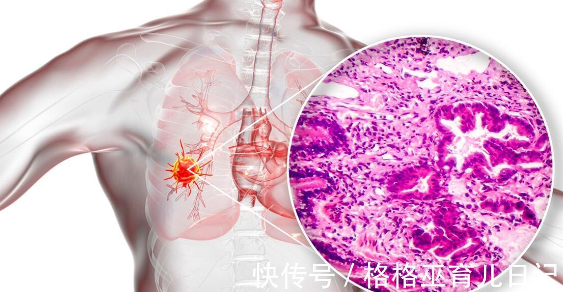 难度系数|什么癌症最“难缠”?这4种癌症,理应“榜上有名”