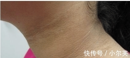 家长|9岁小女孩脖颈发黑洗不掉,经医院检查后,医生的话却让家长笑了