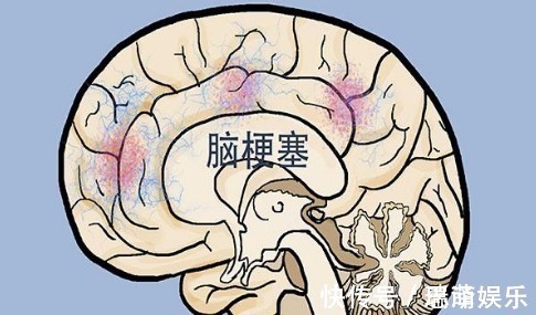 血脂|血脂高的人，多观察手指，若没这几个异常，说明脑梗离你还很远