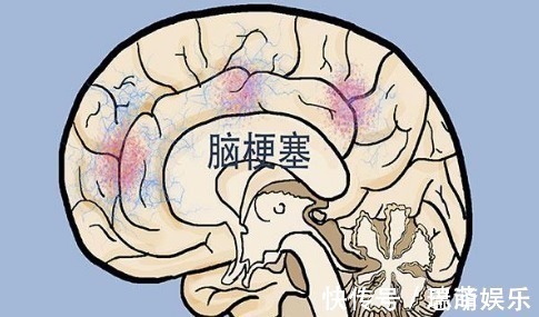 血脂|血脂高的人,多观察手指,若没这几个异常,说明脑梗离你还很远