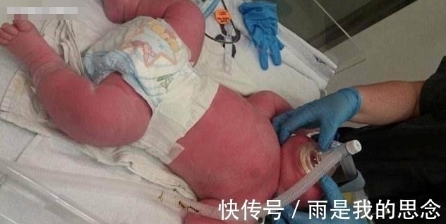 剖腹|孕妈妈剖腹产下宝宝,在场医生都吓一跳,6个月后宝宝是这样!