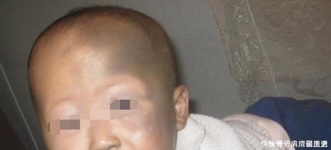 毒素|宝宝出生后身上出现大片红疹和胎记,都是孕妇不忌口吃了这些东西