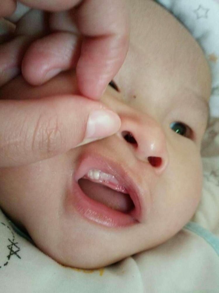 宝宝|女儿生下来就有“2颗牙齿”,婆婆说孩子命苦,儿科医生:拔掉吧