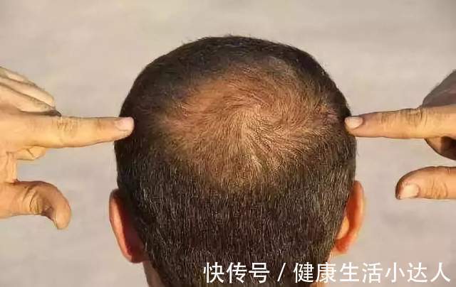 黑米|肾脏“透支”了,身体会亮起4个警示灯,男人不妨自检一下