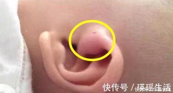 宝妈|儿子的耳朵上有个小洞宝妈试图挤压,导致孩子昏迷,被送到医院