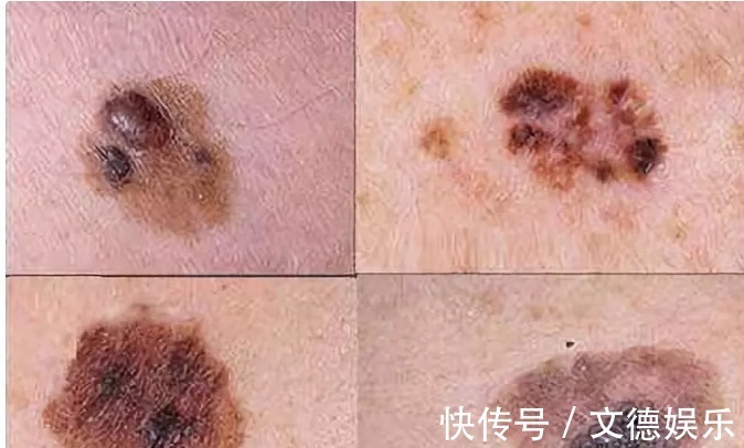 梗阻感|癌症靠近时,身体会如何呼救关键时刻,要读懂身体的求救信号