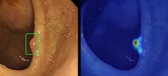 医学影像|字节的医疗野心：2021年「密集投资」后，祭出首个「AI结肠镜」辅诊软件