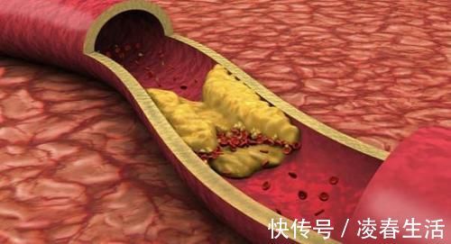 血脂|甘油三酯“害怕”一物,不是大蒜,水里撒1把,血脂乖乖下降