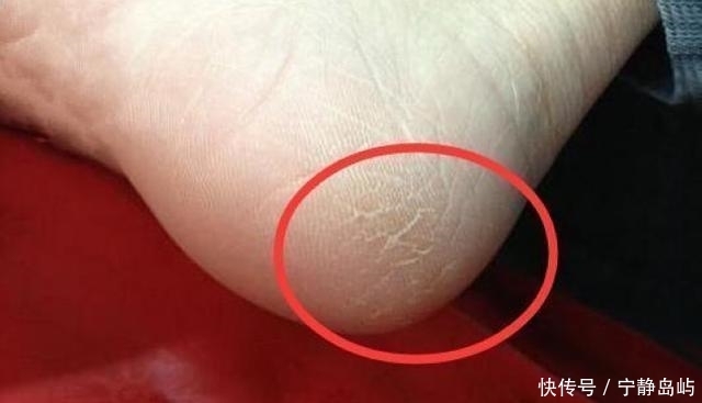 不到40,就脚后跟干裂?教你三招,脚丫重回白嫩