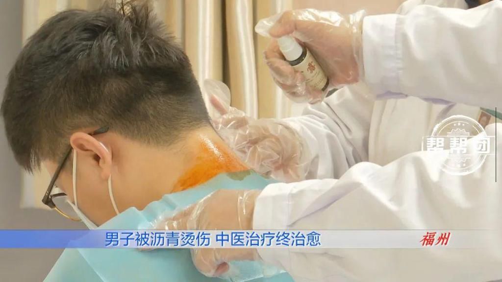  全身|惊心！滚烫的沥青从头浇下，男子全身多处遭遇严重烧烫伤