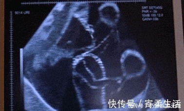 准妈妈|白天安静,晚上胎动频繁,胎儿生物钟乱了吗宝宝不舒服还是巧合