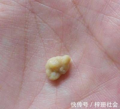 坏习惯|宝宝幼儿园遭人嫌弃,竟是因为口臭问题,取出这样东西后妈妈吐了