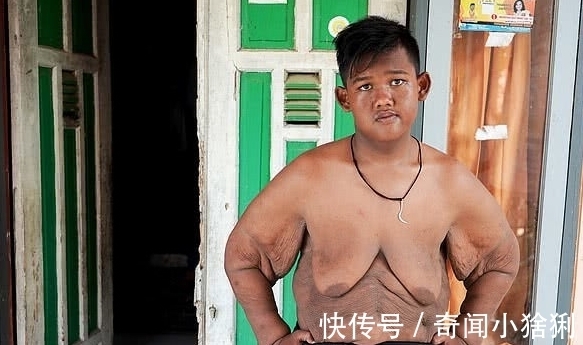 肥胖|“世界上最胖的男孩”重达400斤,减肥成功后,现状帅得认不出来