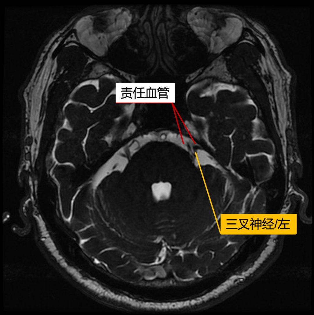 血管|微血管减压术治疗颅神经疾病的经验与体会