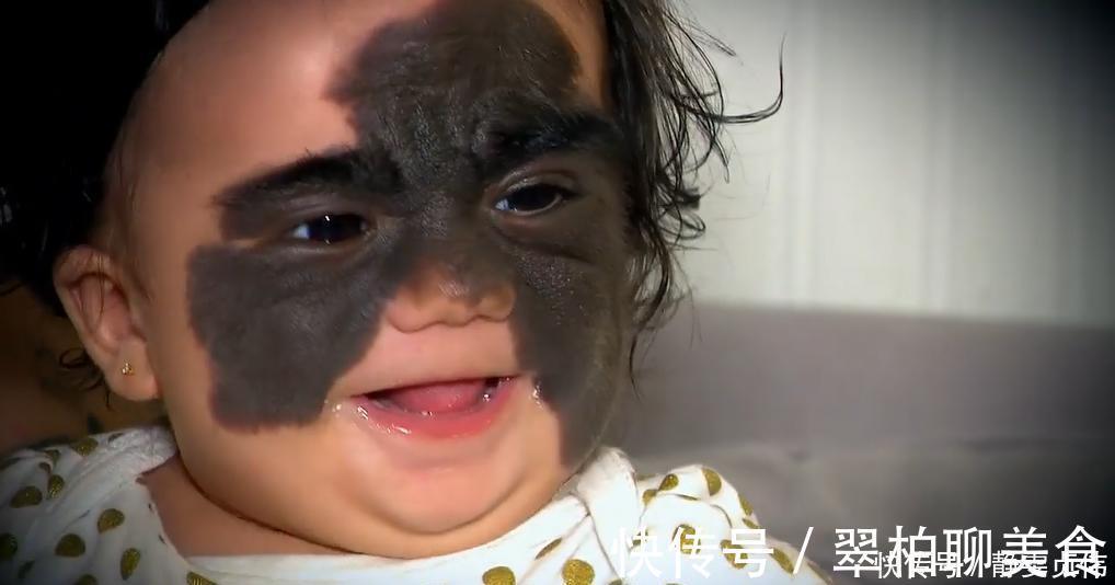 小女孩|那个脸上有“蝙蝠”胎记的女孩,如今生活的怎么样?看完很欣慰