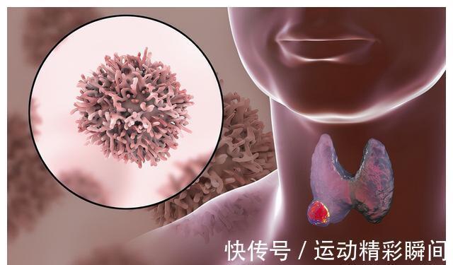 尿碘|甲状腺癌进入全球癌症前十,请注意!是该引起重视了