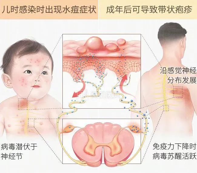 水泡|脸上密密麻麻长满水泡！近期高发，这群深圳人易中招