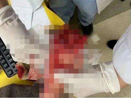 医生|“医生！我家宝宝的手挤进搅拌机里了……”看好孩子！这样的教训太惨痛