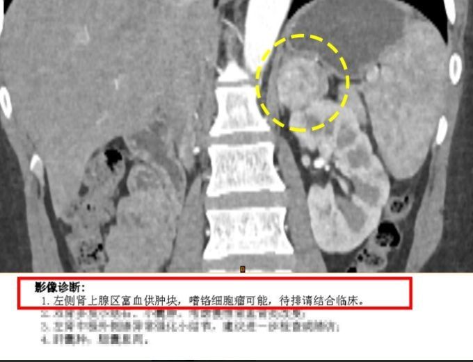 泌尿外科|“胸痛”拍CT意外发现肾上腺肿瘤泌外科专家3D建模精准“排雷”