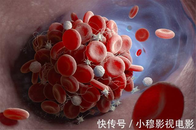 疾病|轻度脑梗早期有5个症状，若能早一点发现，或能遏制疾病的发展