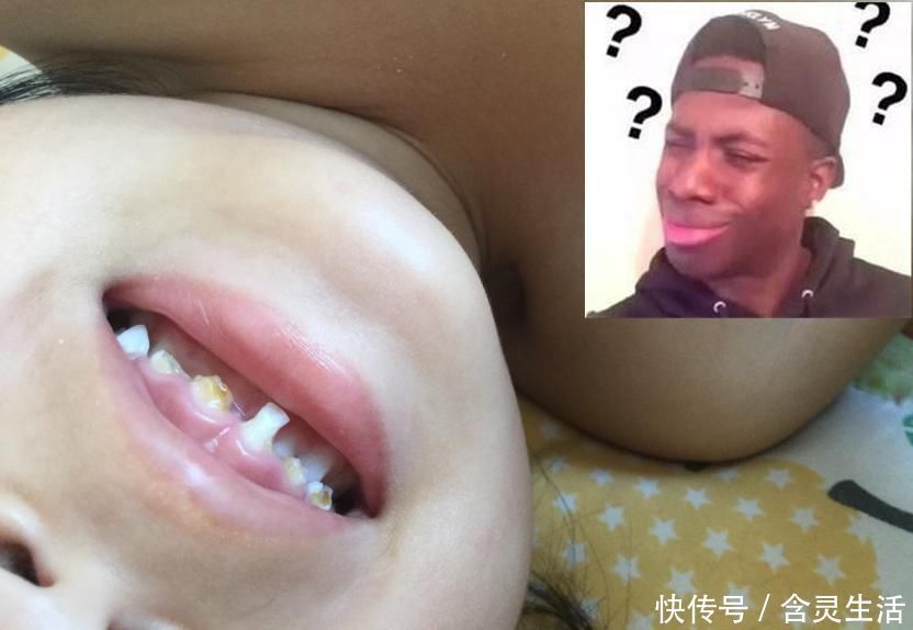 乳牙|4岁孩子一嘴黑牙,妈妈毫不在意认为牙齿能换,牙医叹气无知