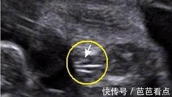 孕囊|记住了!四维单子上有这3个亮点和男女有关