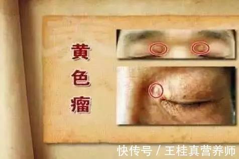 膳食纤维|眼睛是“血脂”的信号灯！眼睛出现3种症状，或说明血脂高了