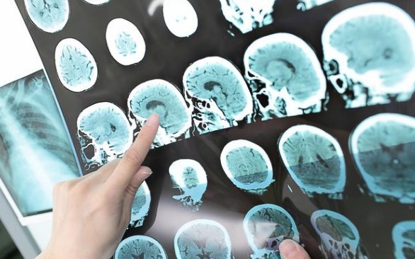 心源性|医生提醒3个饮食坏习惯,加速脑梗发生,中老年人都来看看