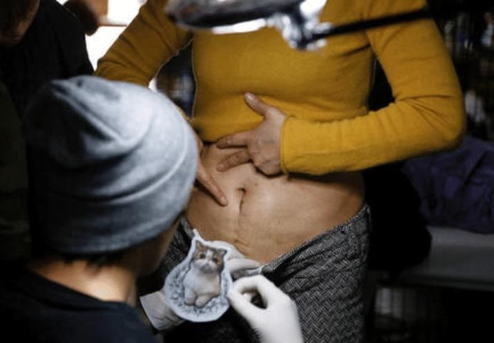 剖腹产|剖腹产多会有3个“后遗症”,二胎宝妈尤为明显,要格外注意