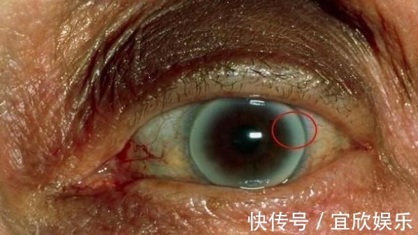 高脂血症|血脂高的人,眼睛可能有3个症状,若没有,说明血脂控制的还不错