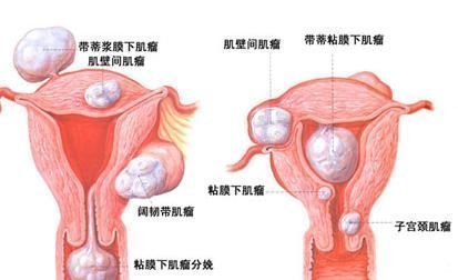 癌变率|实用!息肉一定会癌变吗?肿瘤医院的专家们告诉你答案