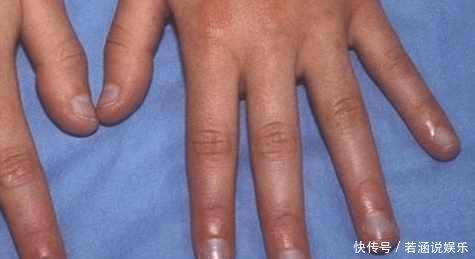 皮肤科|指甲这6个现象,暗示你生病了,要注意,第一个代表患有心脏病