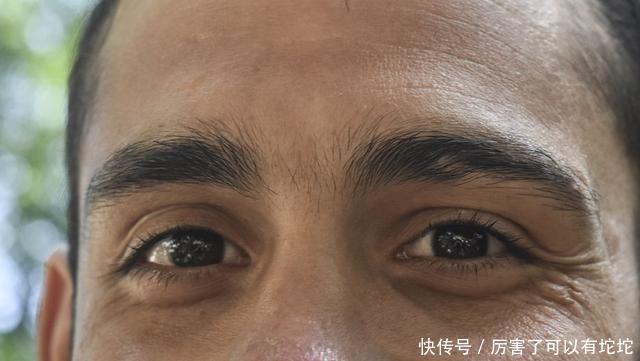 血脂升|心内科医生:血脂高不高看脸就知道,血脂高的人,脸上有3个特征