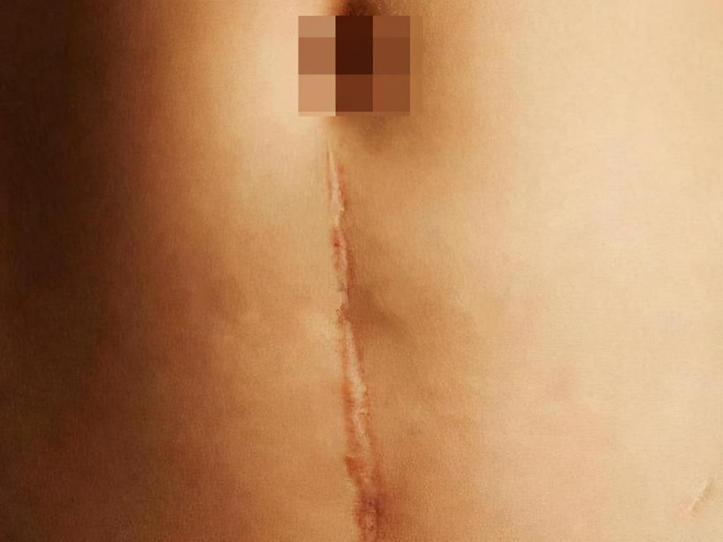 剖腹产|剖腹产选择“横切”还是“竖切”？别轻视这一刀，两者效果大不同