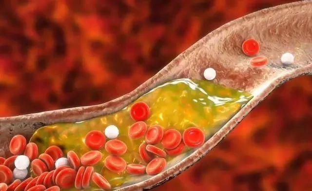 高血脂|甘油三酯偏高,少碰2黄,多吃2果,摒弃2习,血脂或慢慢往下降